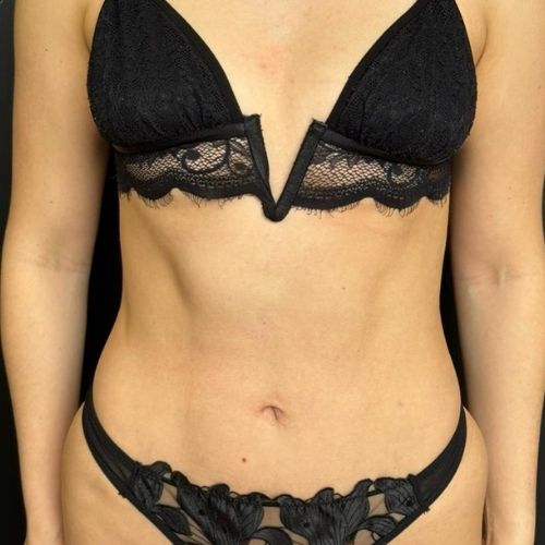 Imagen Liposuccion despues