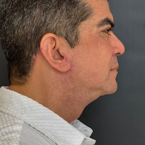 Imagen Cervicoplastia Despoues