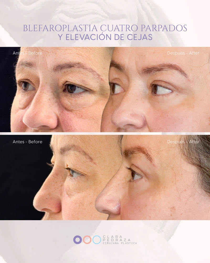 Blefaroplastia Caso 1