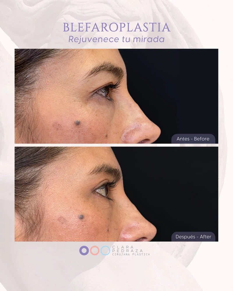 Blefaroplastia Caso 10