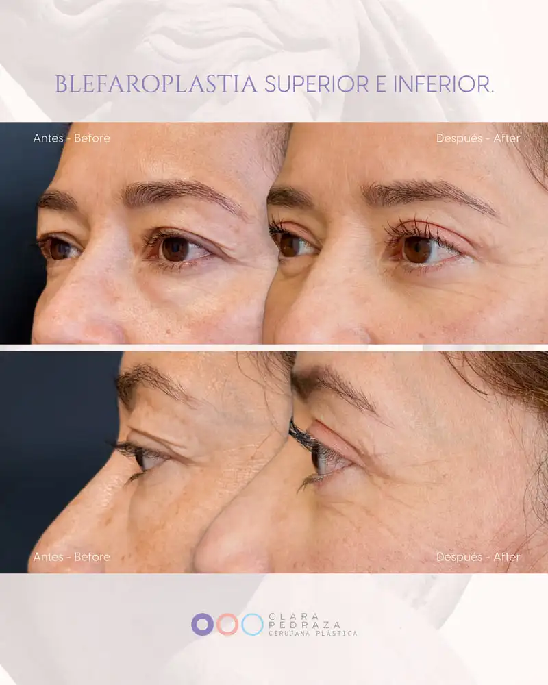 Blefaroplastia Caso 11