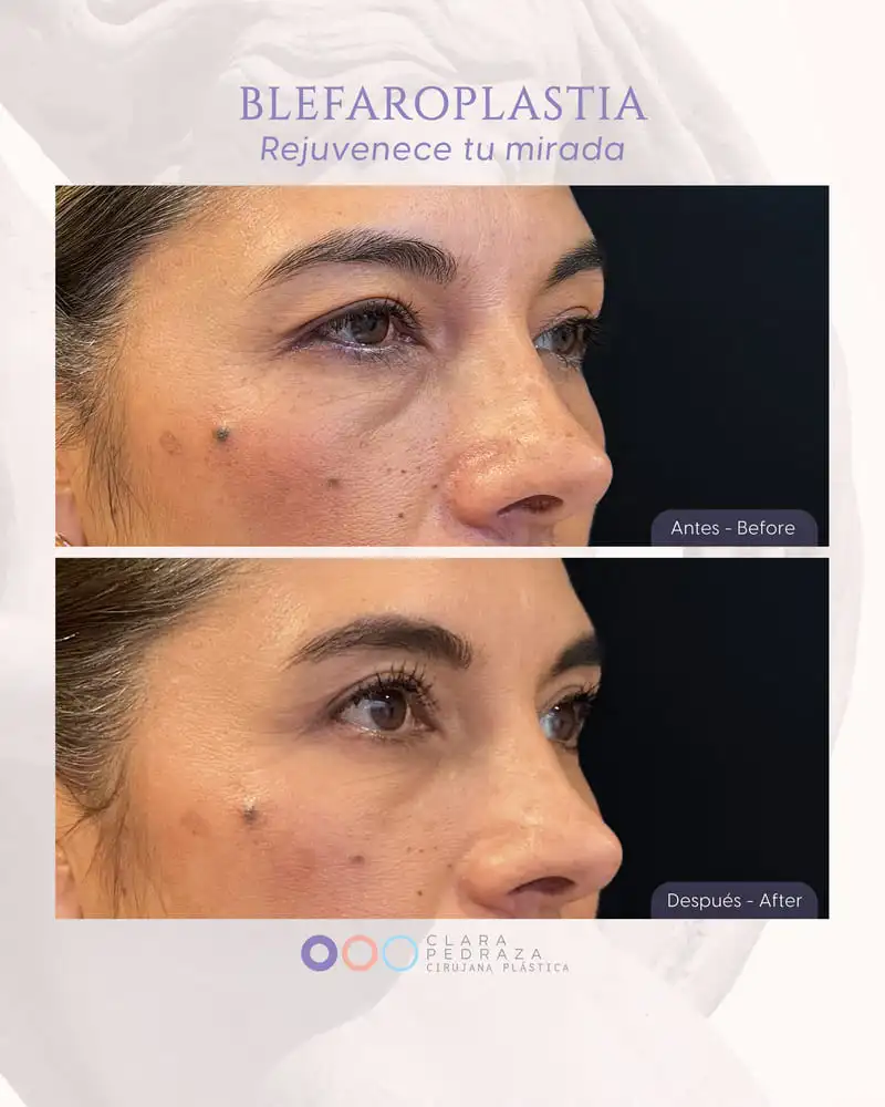 Blefaroplastia Caso 12