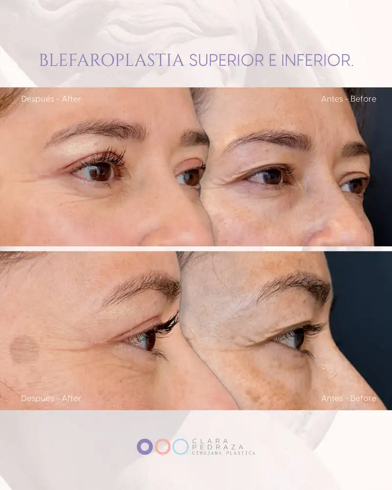 Blefaroplastia Caso 13