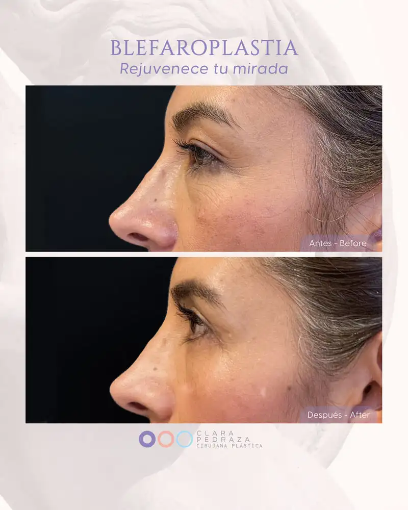 Blefaroplastia Caso 14