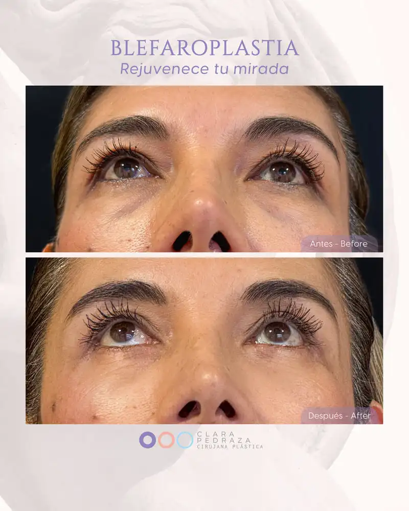 Blefaroplastia Caso 15