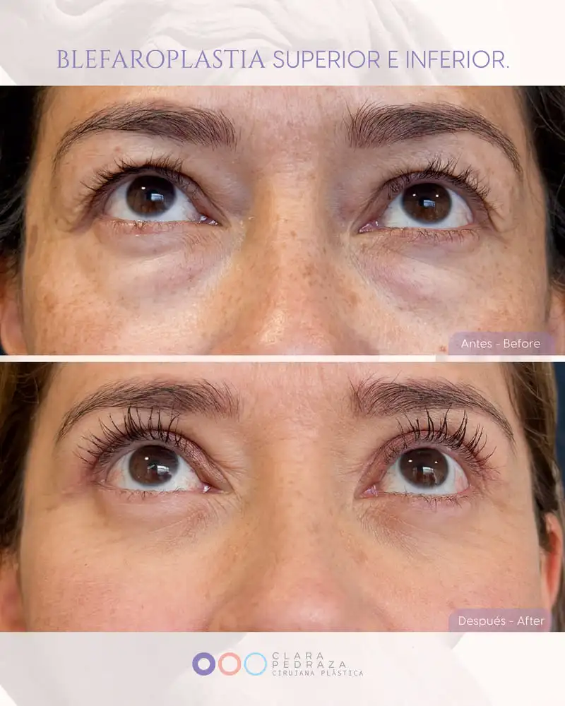 Blefaroplastia Caso 16