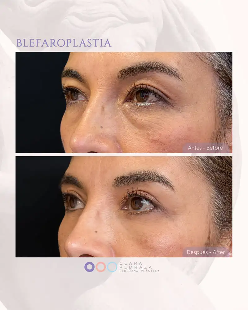 Blefaroplastia Caso 17