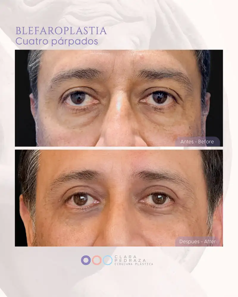 Blefaroplastia Caso 18
