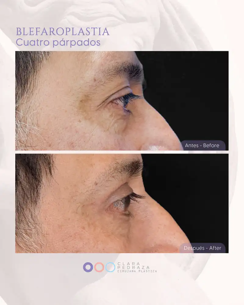 Blefaroplastia Caso 19