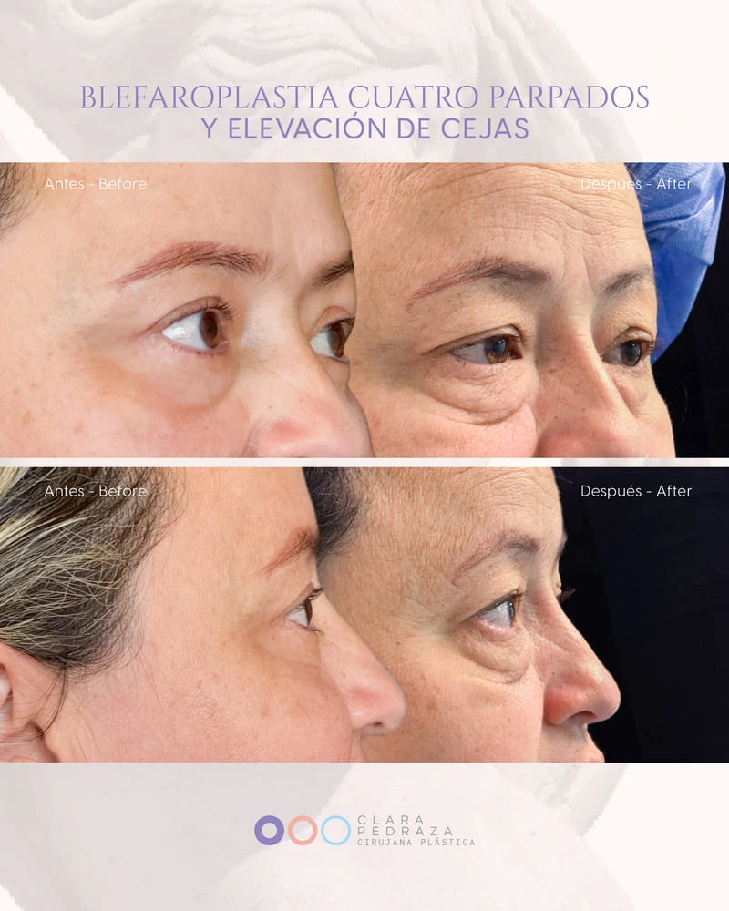 Blefaroplastia Caso 2