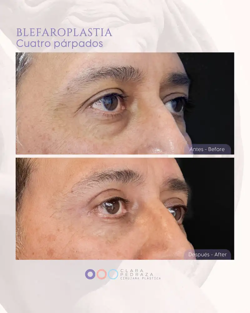 Blefaroplastia Caso 20