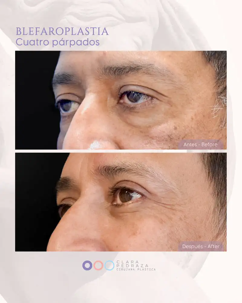 Blefaroplastia Caso 21