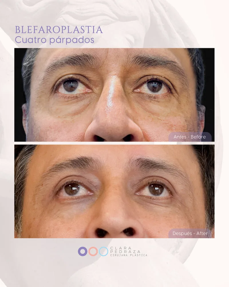 Blefaroplastia Caso 22