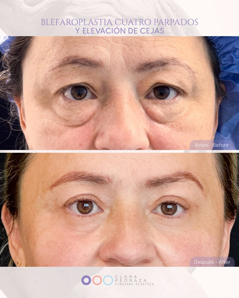 Blefaroplastia Caso 3