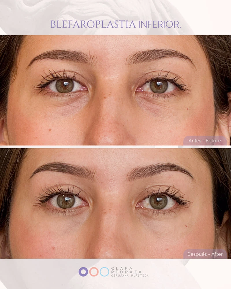 Blefaroplastia Caso 4