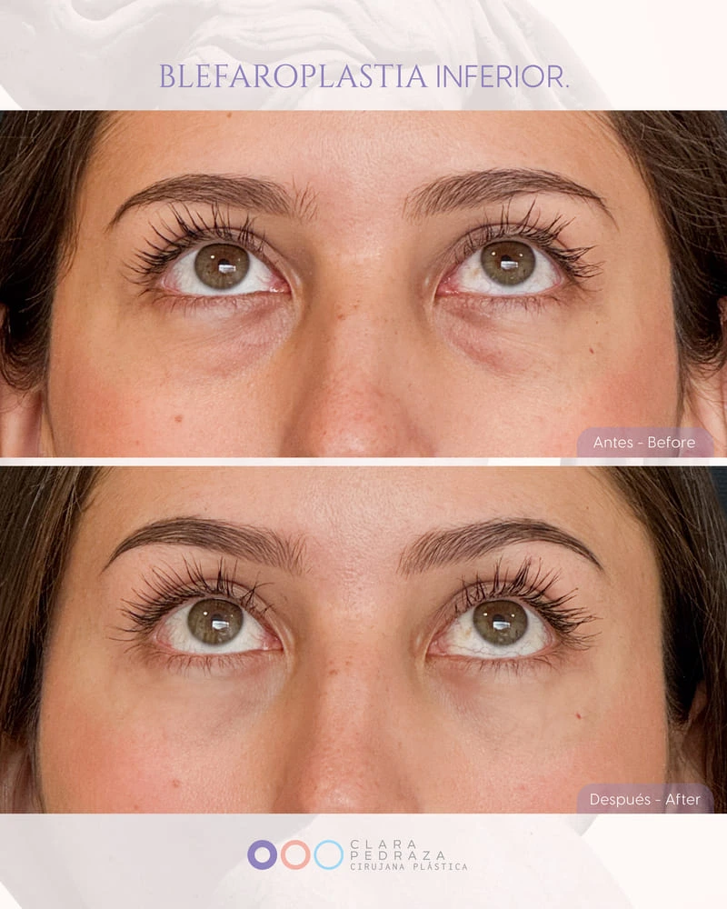 Blefaroplastia Caso 5