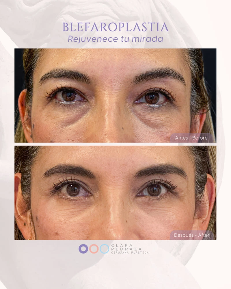 Blefaroplastia Caso 6