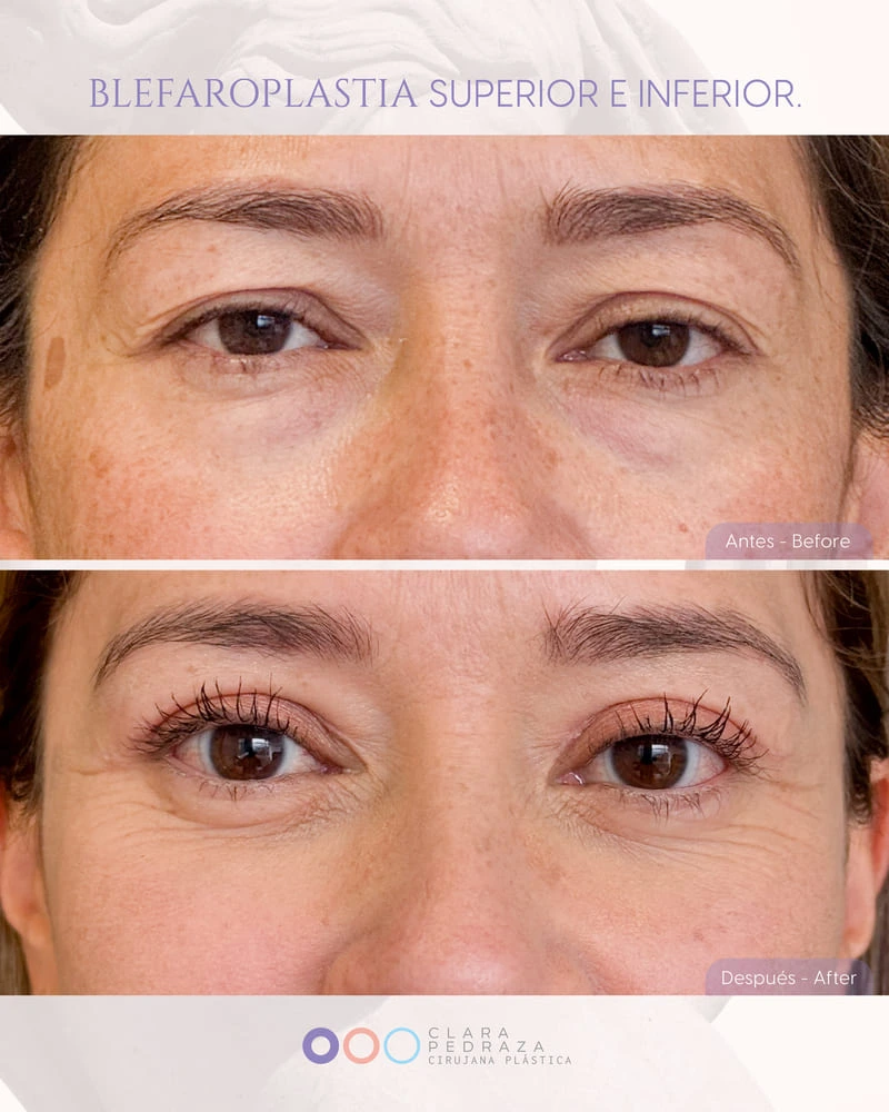 Blefaroplastia Caso 7