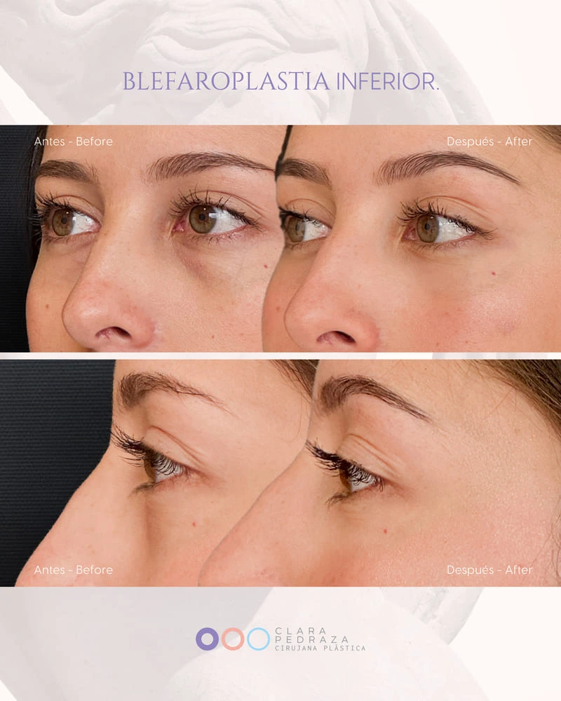 Blefaroplastia Caso 8