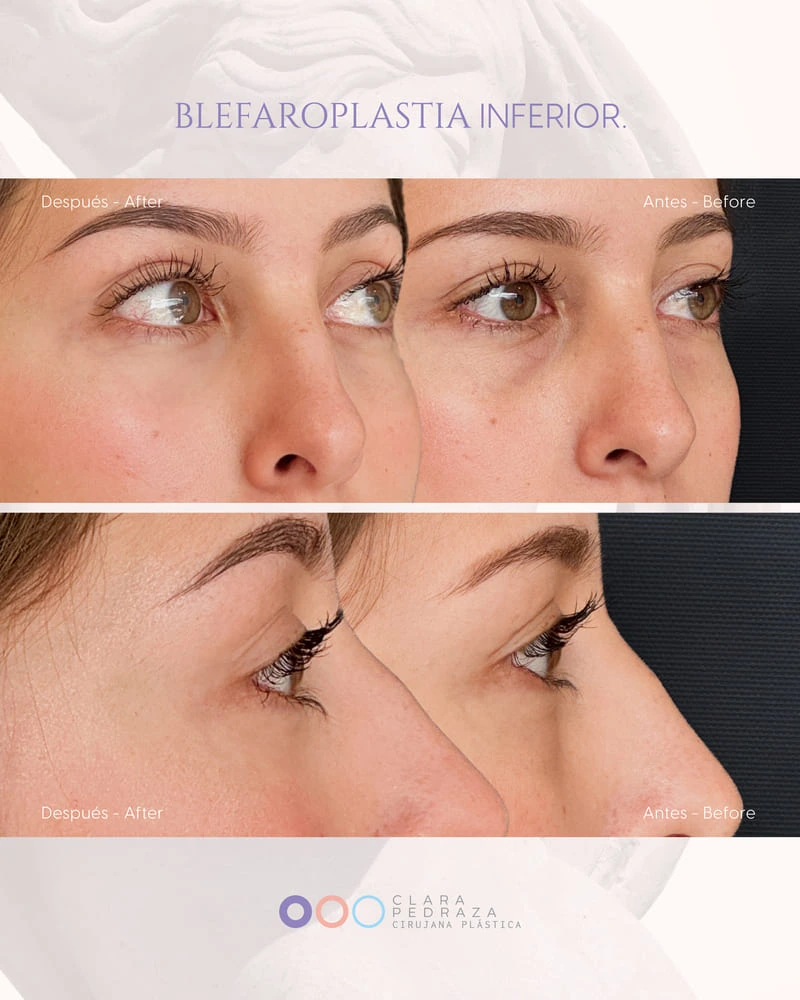 Blefaroplastia Caso 9